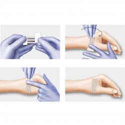 Plasturi pentru inlocuirea suturilor chirurgicale, Omnistrip, 6 x 76 mm - www.naturasanat.ro