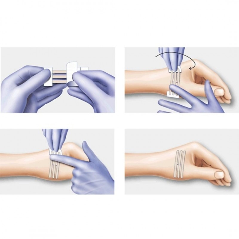 Plasturi pentru inlocuirea suturilor chirurgicale, Omnistrip, 6 x 76 mm - www.naturasanat.ro